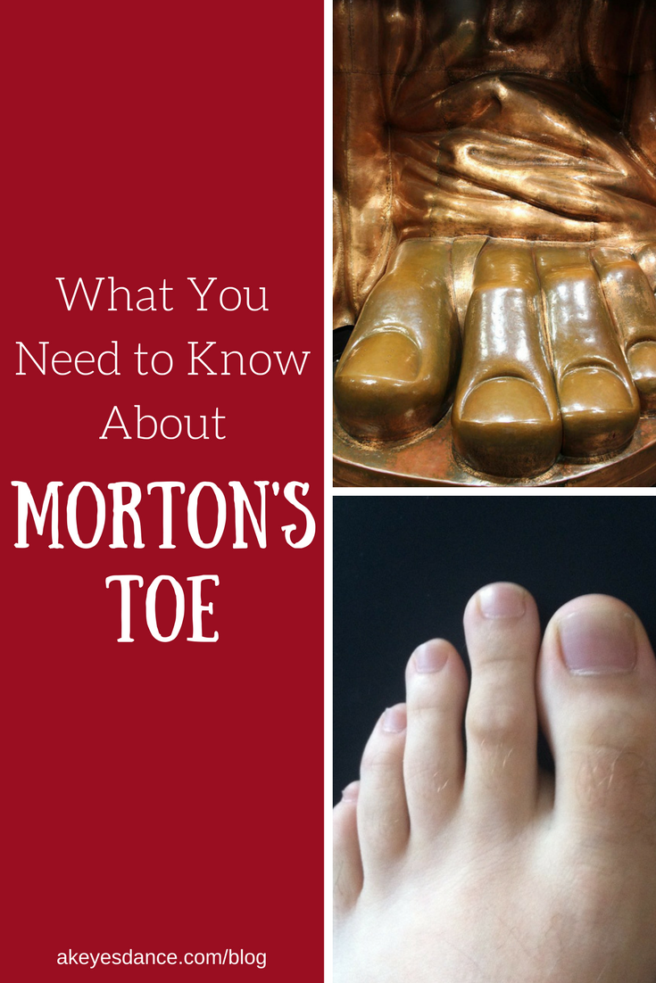 What to know about Morton's Toe blog post by Abigail Keyes